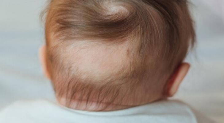 أسباب ضعف الشعر عند الأطفال