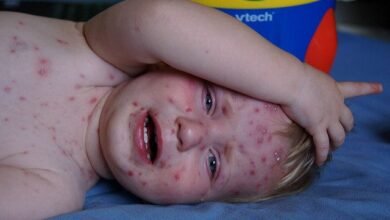ما هو علاج جدري الماء عند الأطفال