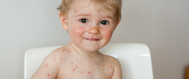 علاج جدري الماء عند الأطفال