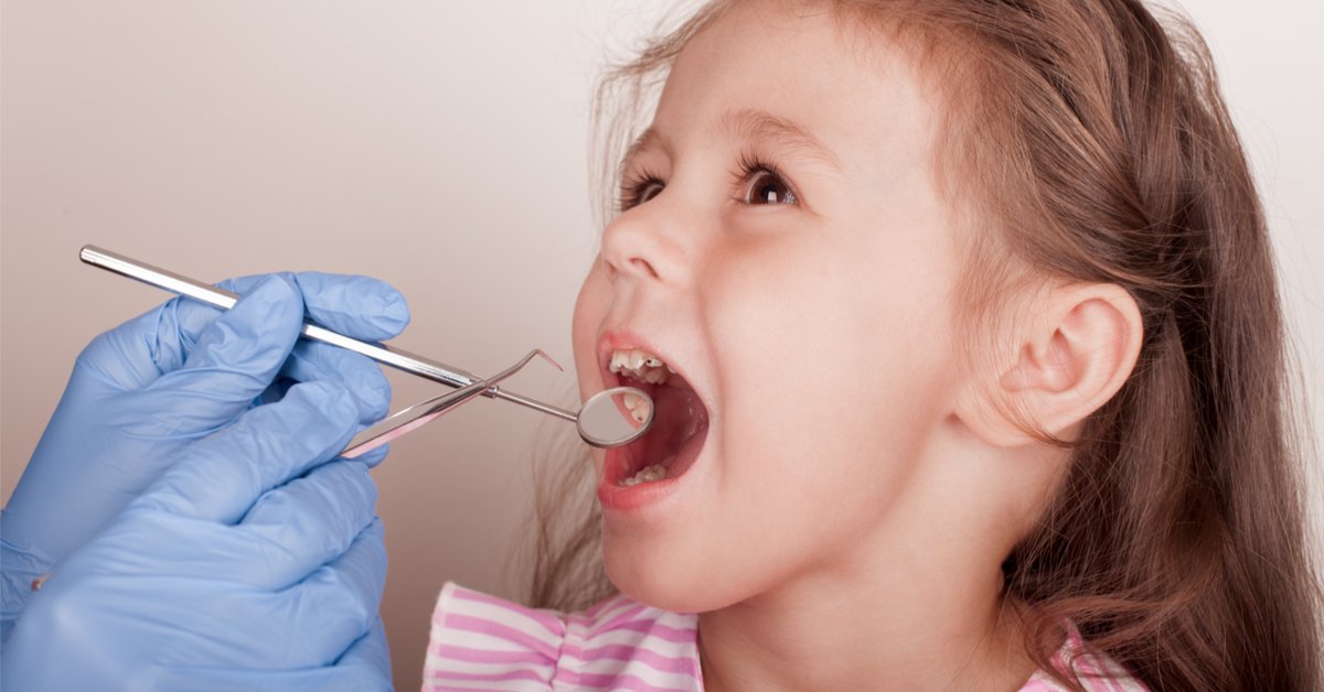 التهاب اللثة عند الأطفال