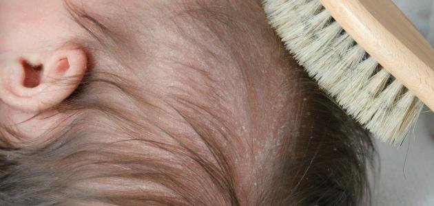 أسباب ضعف الشعر عند الأطفال