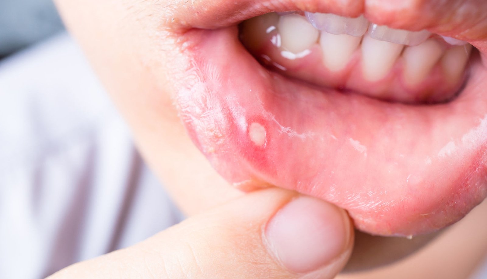 كيفية علاج فطريات الفم عند الأطفال