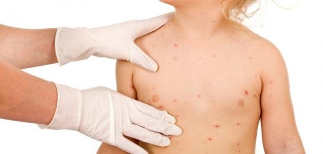 علاج جدري الماء عند الأطفال