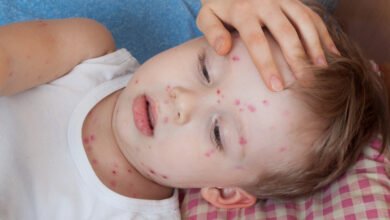 علاج سريع لجدري الماء