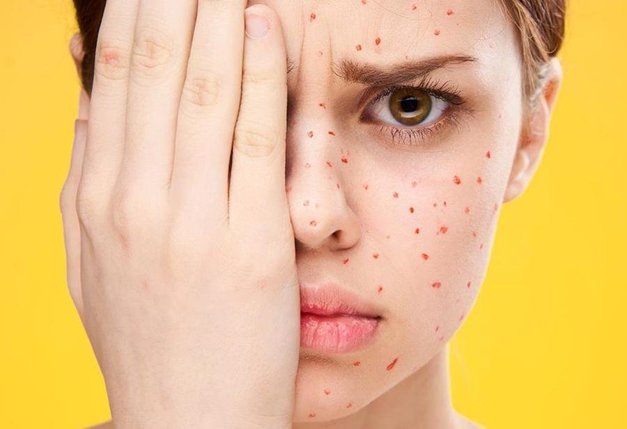 علاج جدري الماء عند الكبار