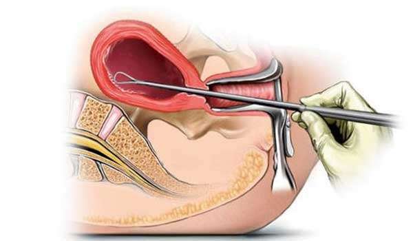تنظيف الرحم بعد الإجهاض طبيعيًا