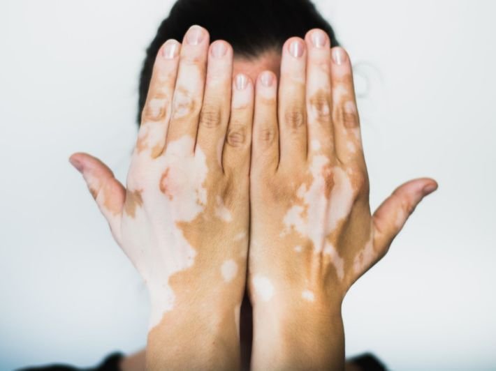 علاج نقص صبغة الجلد