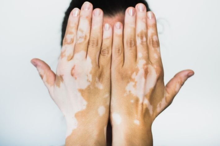 علاج نقص التصبغ عند الأطفال