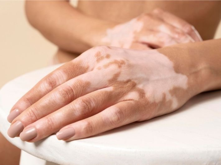 علاج نقص صبغة الجلد