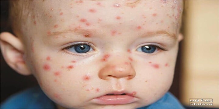 شكل حبوب الجدري بالصور