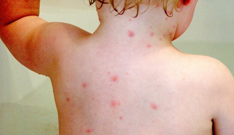 مدة علاج الجدري عند الأطفال