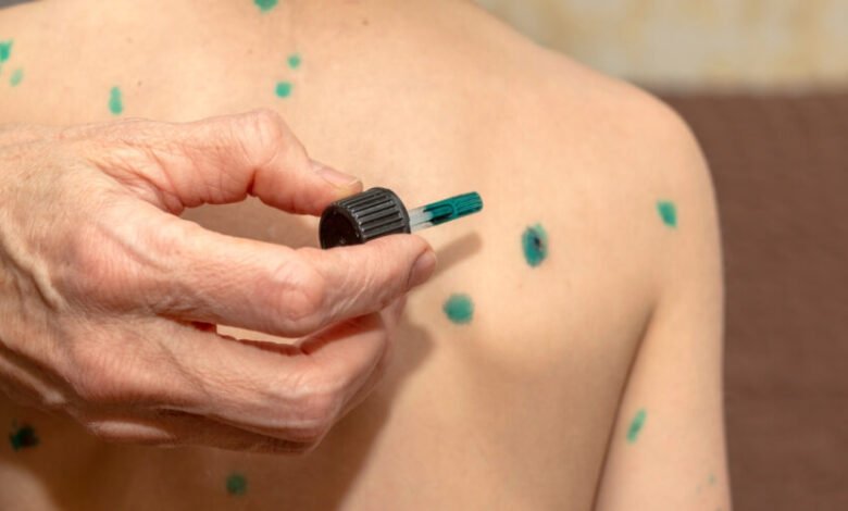 دواء الجدري المائي