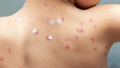 دواء الجدري للاطفال