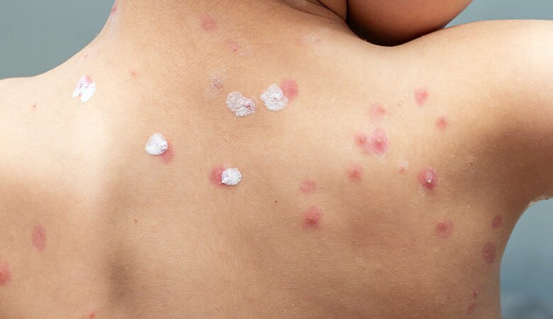 دواء الجدري للاطفال