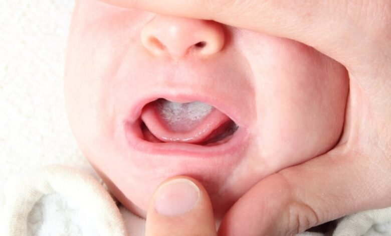 دواء فطريات الفم للاطفال