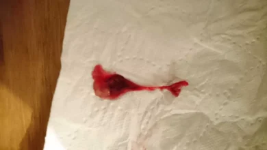 علامات نزول الكيس مع الدورة