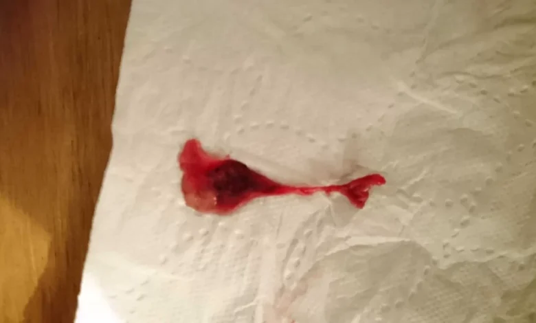 علامات نزول الكيس مع الدورة