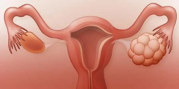 كيف ينزل كيس المبيض مع الدورة