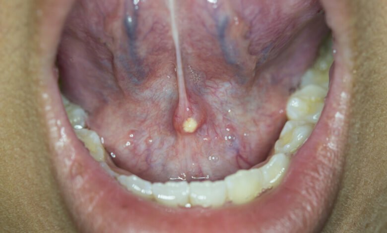 أسباب الإصابة بحبة اللسان