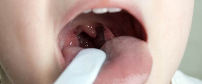 أسباب التهاب الحنجرة