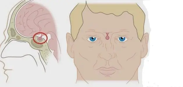 أسباب التهاب الغدة النخامية