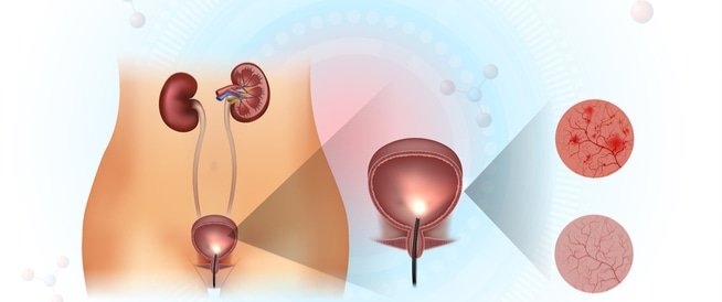 أسباب التهاب المثانة