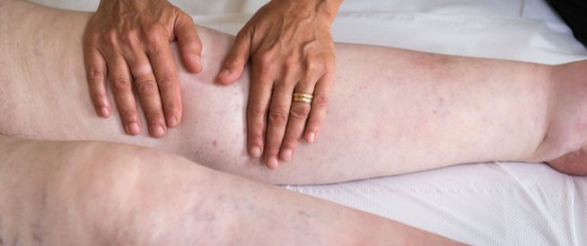 أسباب انتفاخ الفخذ فوق الركبة