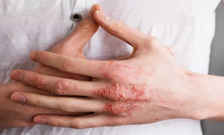 أعراض إكزيما اليدين