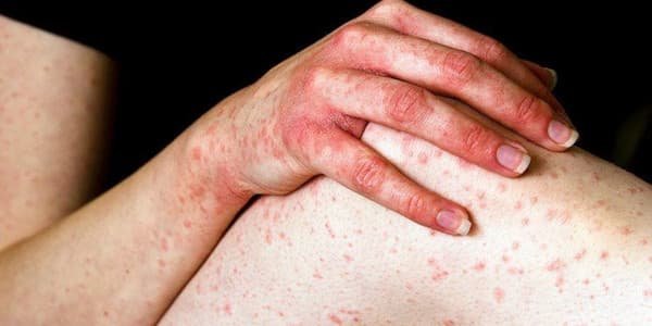 أعراض حساسية العسل