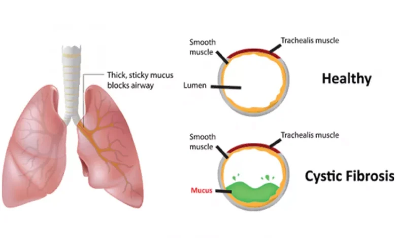 التليف الكيسي