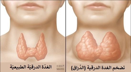 الشفاء من الغدة الدرقية