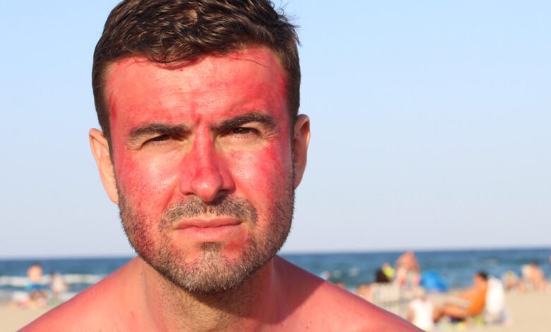 حروق الشمس للوجه