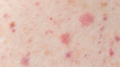 سبب وجود بقع حمراء على الجلد