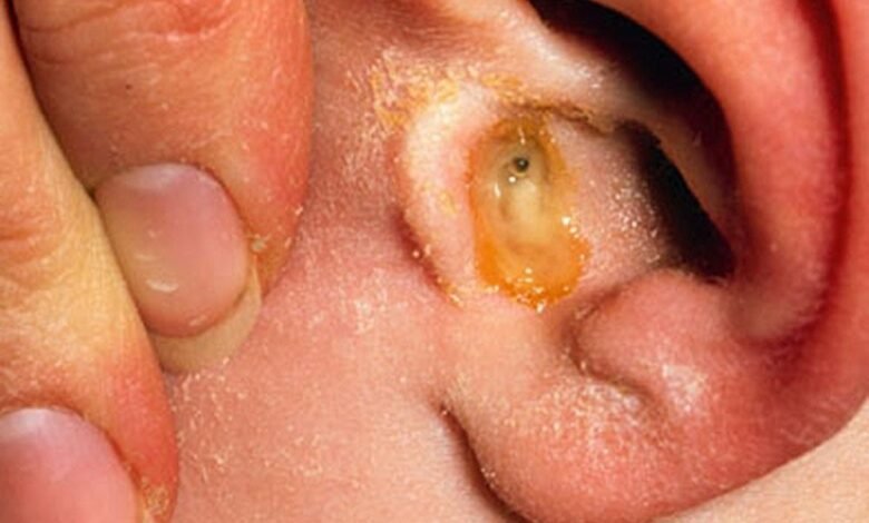 علاج التهاب الأذن