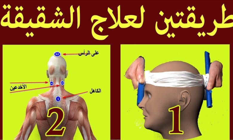 علاج الشقيقة بالحجامة