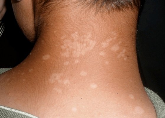 علاج تينيا الرقبة