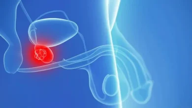 كيف تتأثر العلاقة الزوجية بعد استئصال البروستاتا