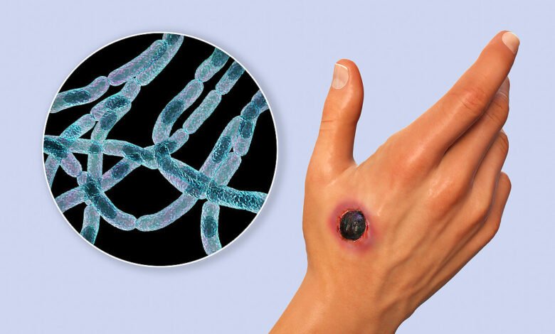 مرض الجمرة الخبيثة