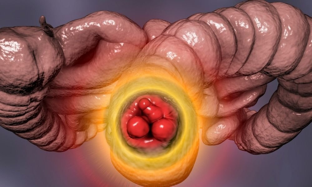 أعراض البواسير الداخلية