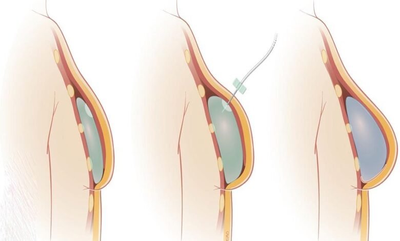اختلاف حجم الثدي