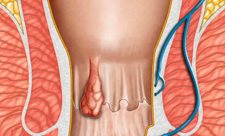 أعراض البواسير الداخلية