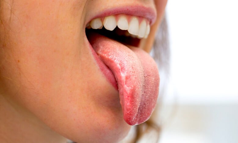 تقرحات اللسان