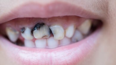 أسباب تسوس الأسنان الأمامية وكيفية تجنبه