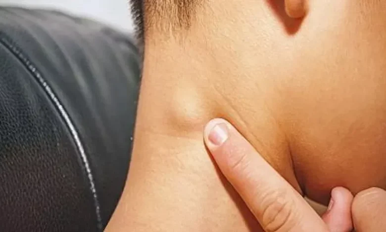 أعراض سرطان الغدد اللمفاوية