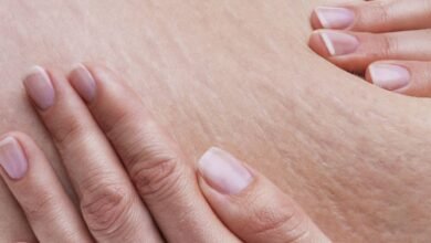 أعراض نقص الكولاجين