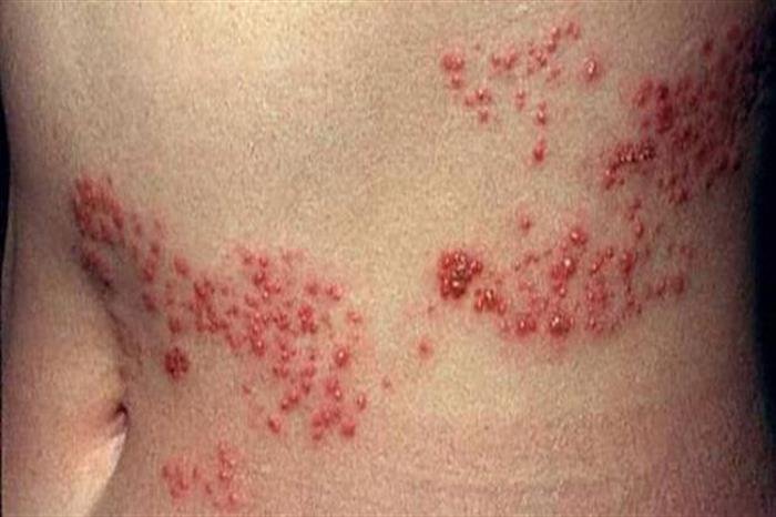 الاستحمام عند الإصابة بالحزام الناري