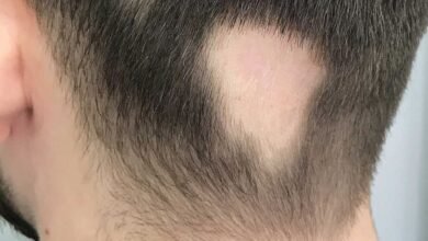 طرق لعلاج الثعلبة في الرأس