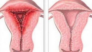 علاج التهاب الرحم