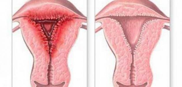 علاج التهاب الرحم