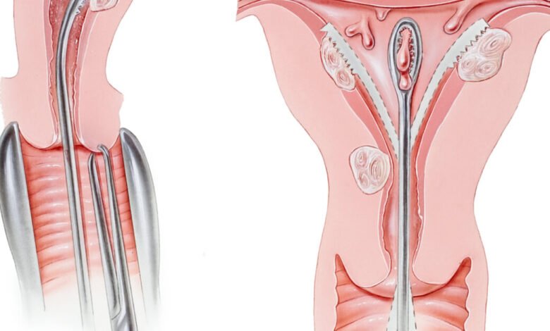 عملية تنظيف الرحم